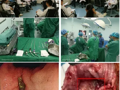 我院普外科在MDT团队协作下成功完成首例腹腔镜下远端胃癌根治术（毕II式）